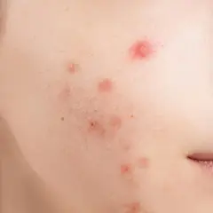Skóra z niedoskonałościami, zaczerwienieniami i śladami po trądziku. Widoczne są pojedyncze wypryski. To mogą być dermapen efekty po zabiegu.
