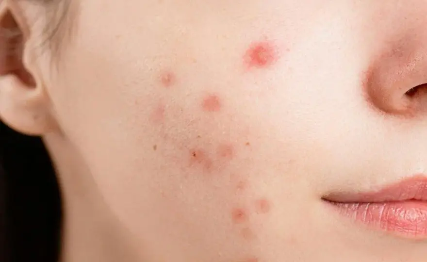 Dermapen efekty - Kiedy widać poprawę i ile zabiegów potrzeba?